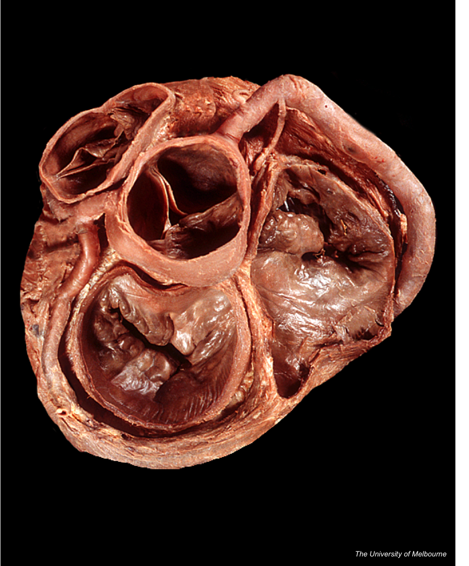 Heart Valve Anatomy